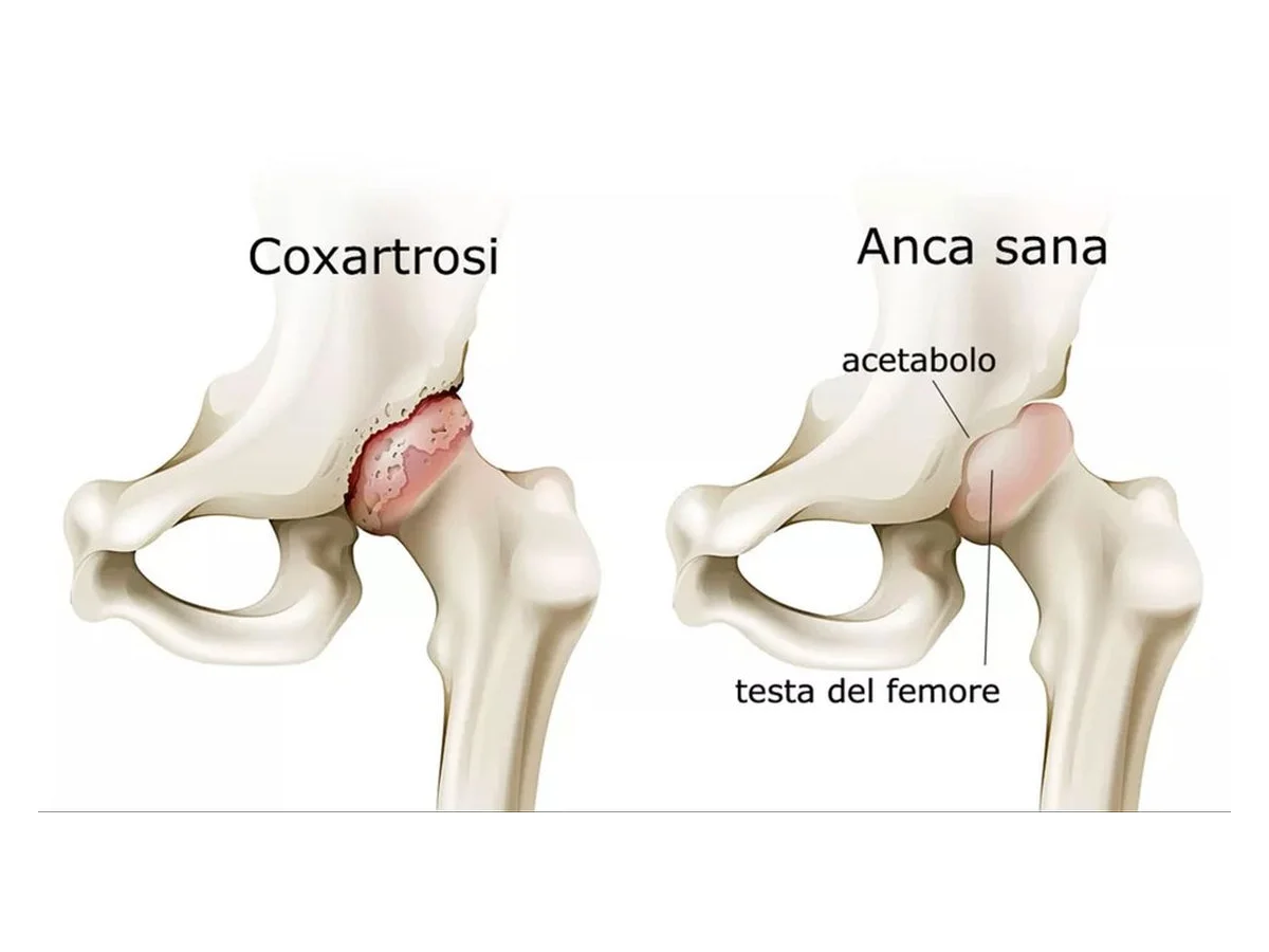 Confronto tra anca con coxartrosi e anca sana: acetabolo e testa del femore