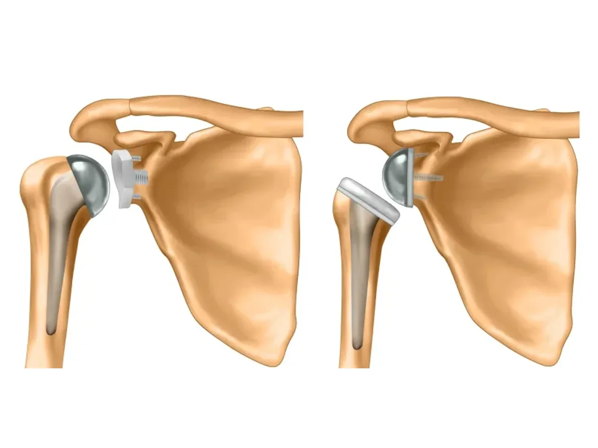 Protesi di spalla anatomica e protesi inversa