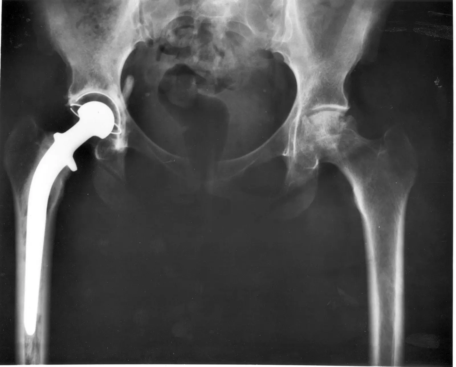 Radiografia di una protesi d'anca
