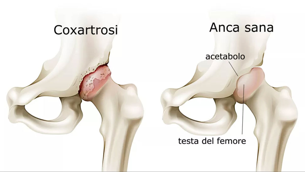 Artrosi Anca